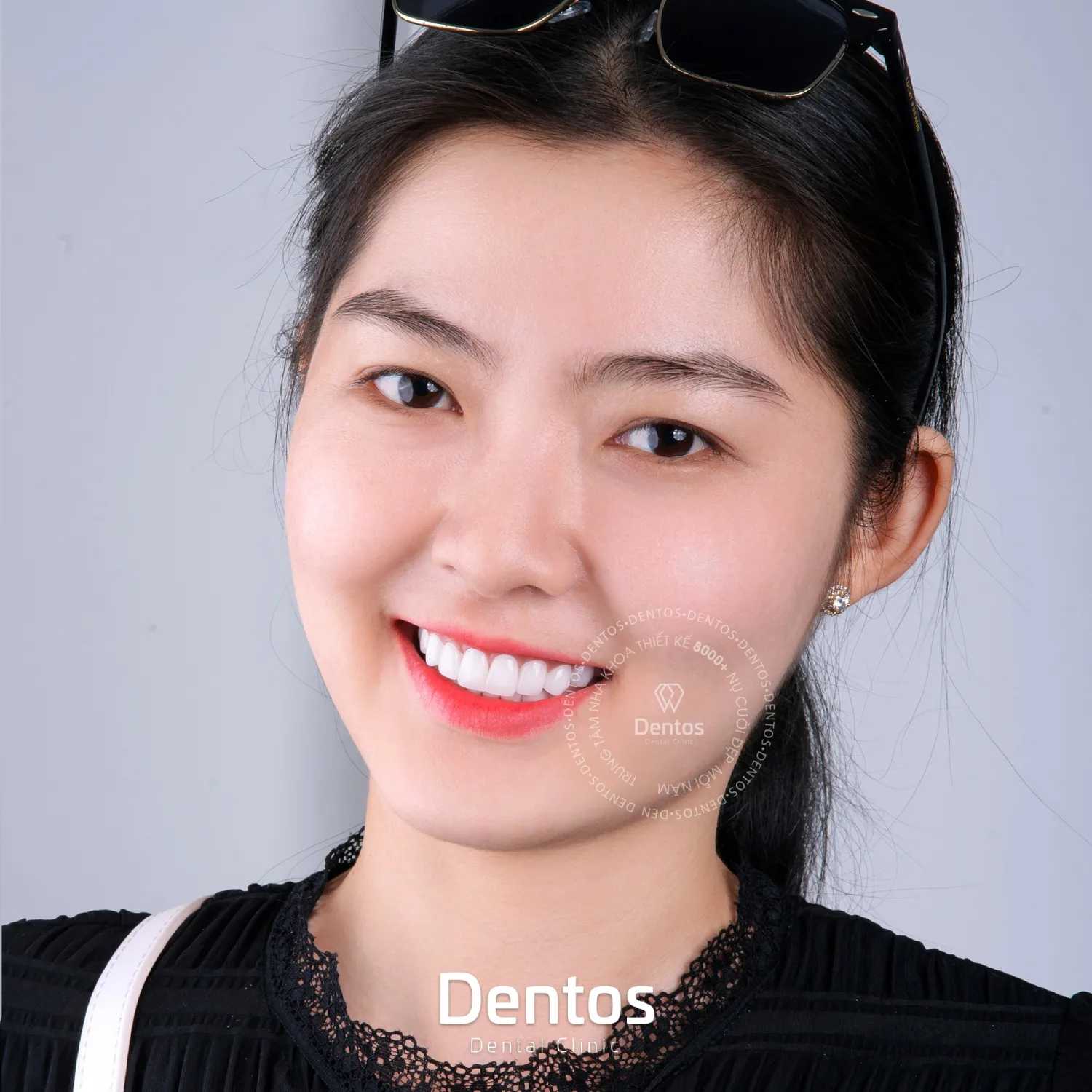 Làm răng sứ giúp khắc phục hiệu quả các khuyết điểm của răng